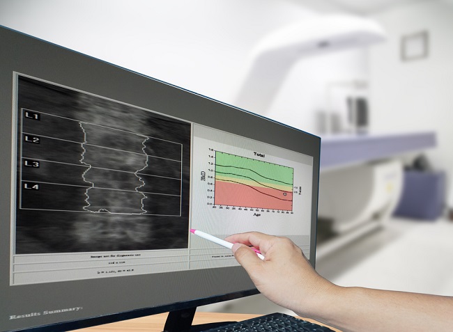 An image of a doctor pointing to a bone density scan on a screen