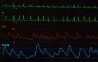 Atrial Fibrillation (AF) Trial Image