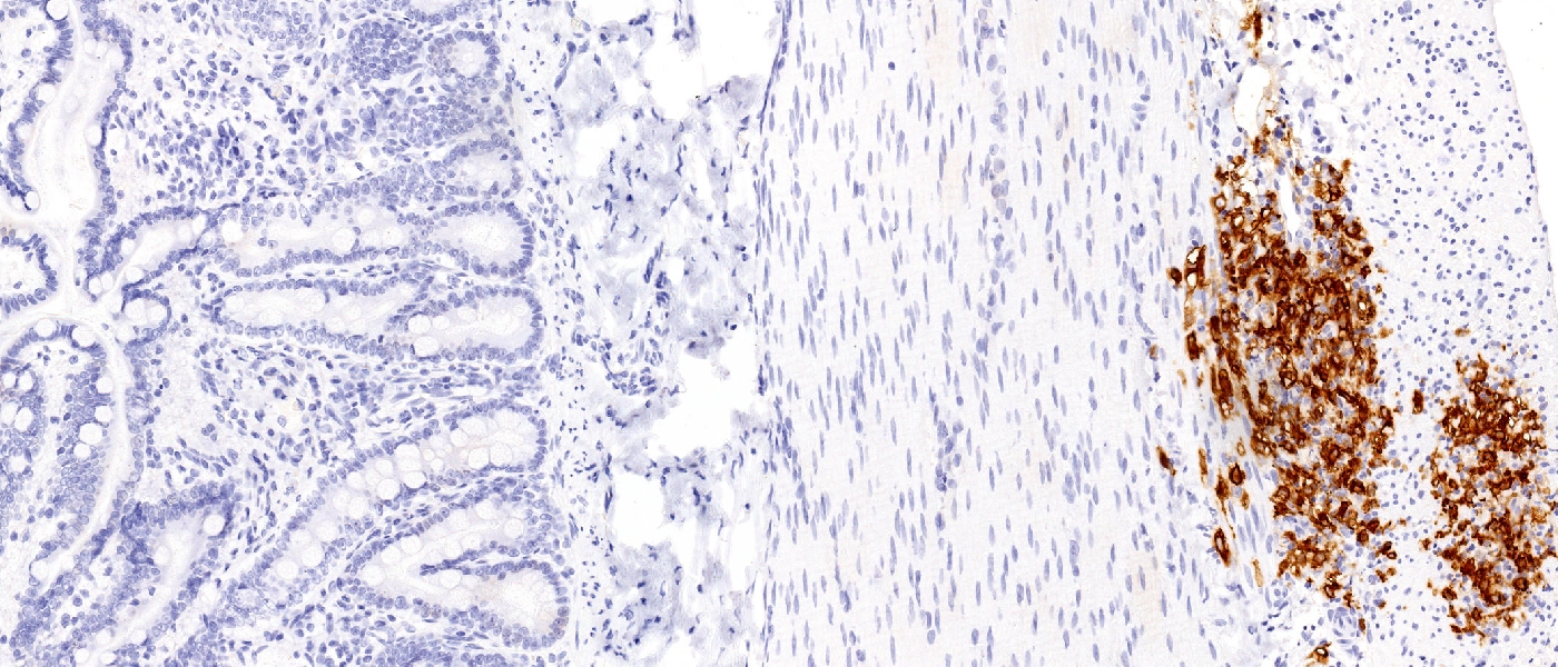 Feline Intestine, IHC Satining with Coronavirus
