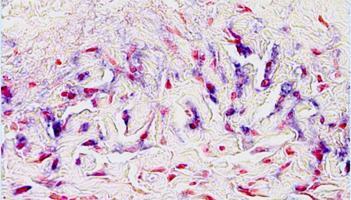 Rheumatoid arthritis synovium