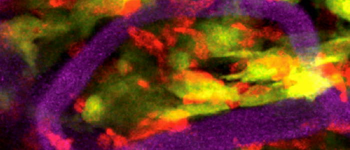 Trypanosome meningitis