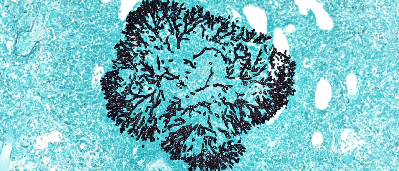 Grocott methenamine silver (GMS) stain for fungi